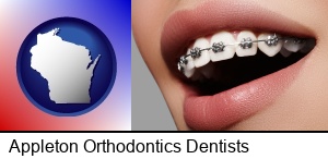 Appleton, Wisconsin - orthodontic braces