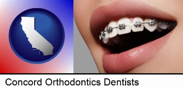 orthodontic braces in Concord, CA