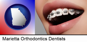 orthodontic braces in Marietta, GA