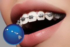 hawaii map icon and orthodontic braces