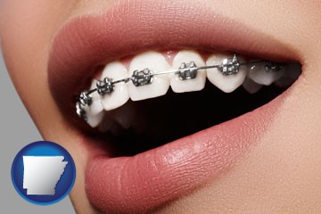 orthodontic braces - with Arkansas icon