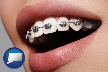 orthodontic braces - with Connecticut icon