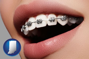 orthodontic braces - with Indiana icon