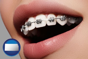 orthodontic braces - with Kansas icon