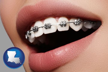 orthodontic braces - with Louisiana icon