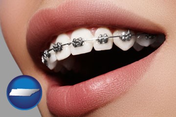 orthodontic braces - with Tennessee icon