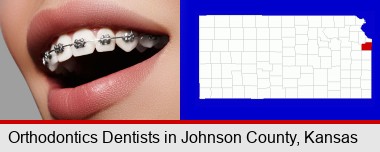 orthodontic braces; Johnson County highlighted in red on a map