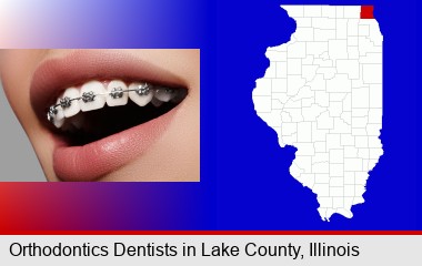 orthodontic braces; LaSalle County highlighted in red on a map