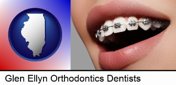 orthodontic braces in Glen Ellyn, IL