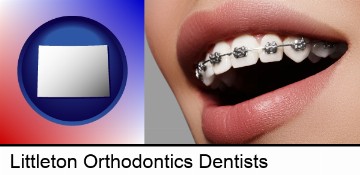 orthodontic braces in Littleton, CO