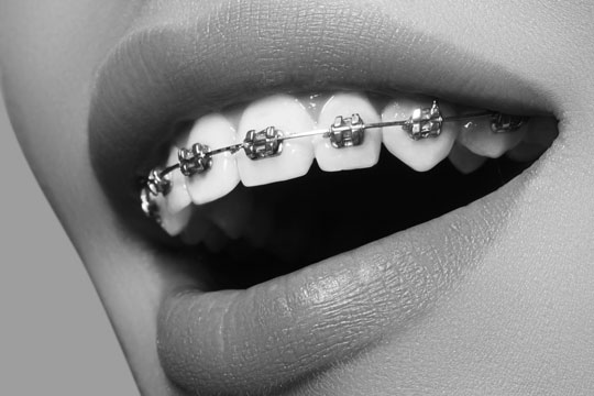 orthodontic braces