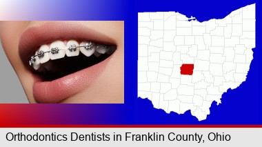 orthodontic braces; Franklin County highlighted in red on a map