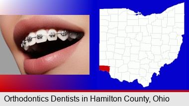 orthodontic braces; Hamilton County highlighted in red on a map