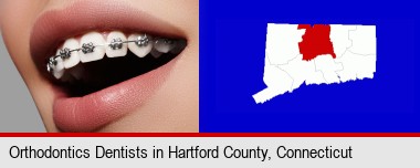 orthodontic braces; Hartford County highlighted in red on a map