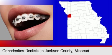 orthodontic braces; Jackson County highlighted in red on a map