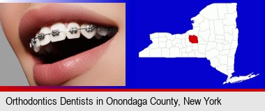 orthodontic braces; Onondaga County highlighted in red on a map