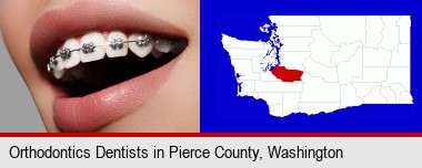 orthodontic braces; Pierce County highlighted in red on a map