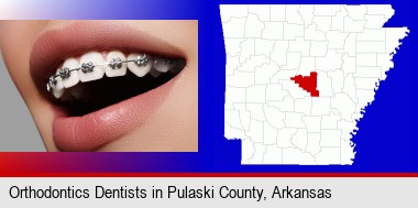 orthodontic braces; Pulaski County highlighted in red on a map