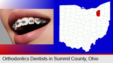 orthodontic braces; Summit County highlighted in red on a map