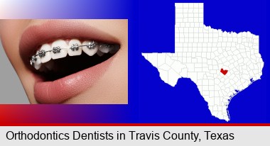 orthodontic braces; Travis County highlighted in red on a map