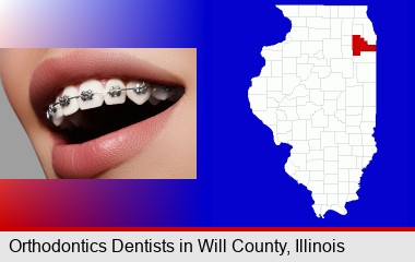 orthodontic braces; Will County highlighted in red on a map